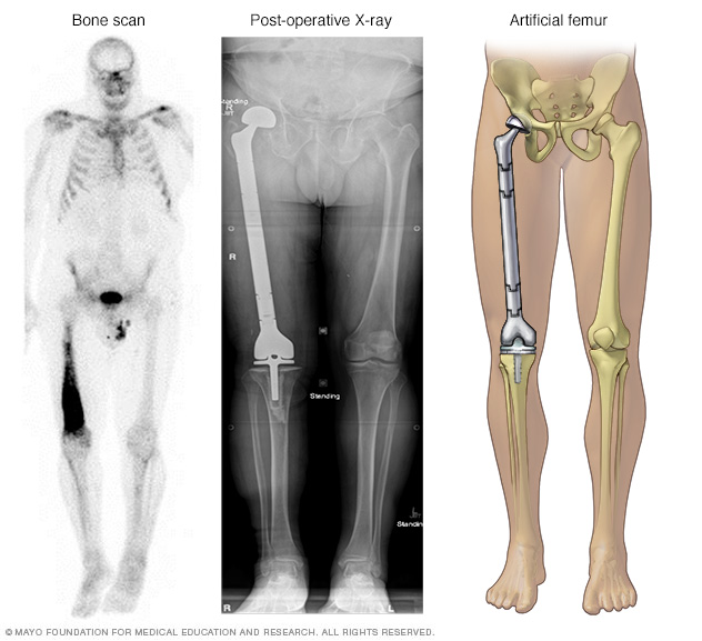 Cancerous thighbone replaced with artificial components