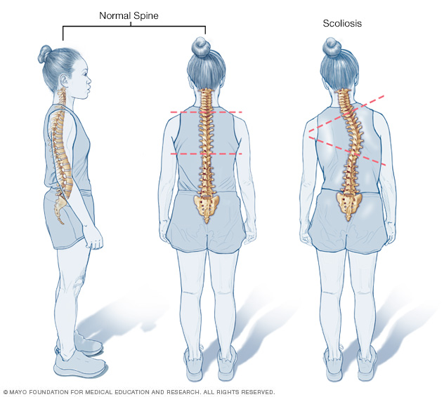 Comparing typical curves in spine with scoliosis