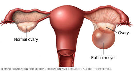 Follicular cyst on ovary
