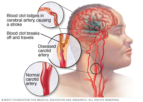 A diseased carotid artery and a blood clot in a cerebral artery