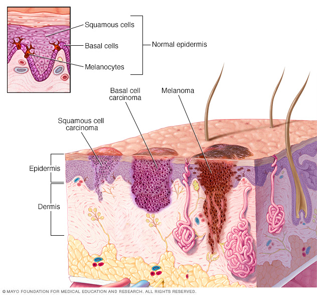 Where skin cancer develops