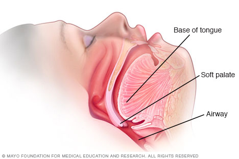 Illustration showing how narrowed airway contributes to snoring