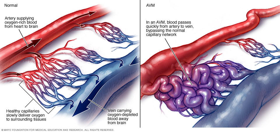 AVM blood flow