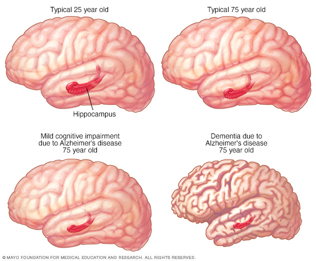 Changes in brain structure in MCI and Alzheimer's disease