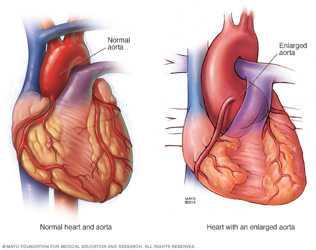 Aneurysm at aortic root