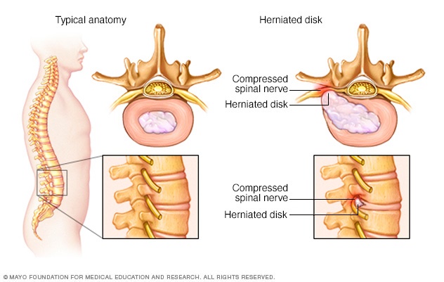 Herniated disk