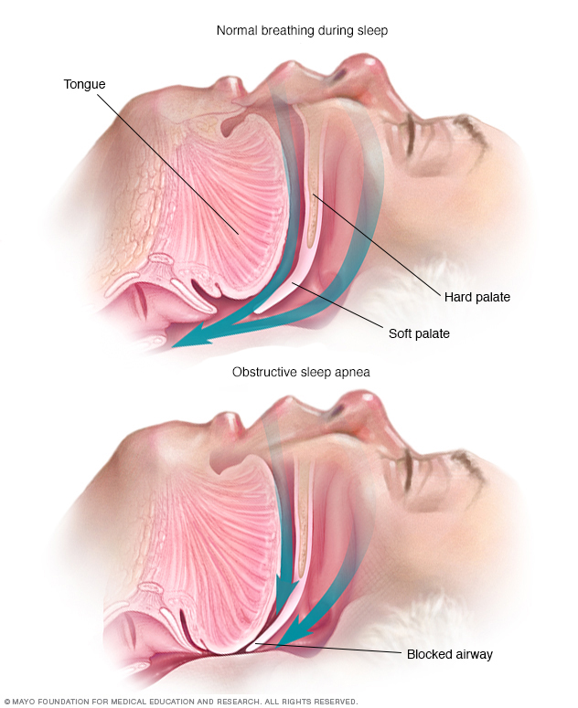An open airway during typical breathing during sleep and a blocked airway in someone who has obstructive sleep apnea.