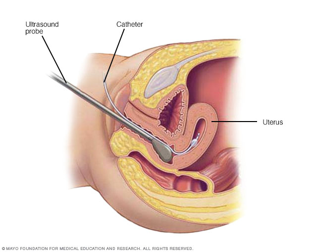 Illustration showing what happens during hysterosonography