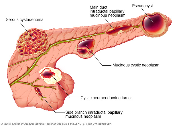 Types of pancreatic cysts 