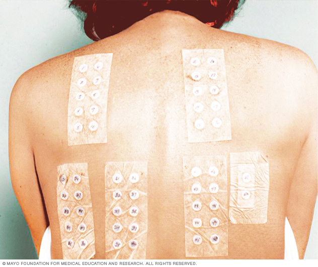 Patch testing on the back helps identify what you're allergic to.