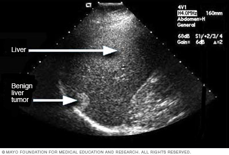 Ultrasound image of a benign liver tumor