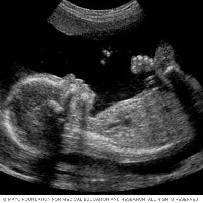 A fetal ultrasound slide showing baby's profile 
