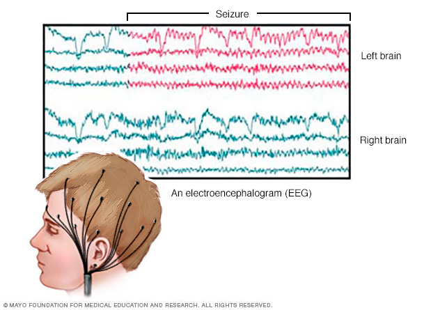 EEG brain activity