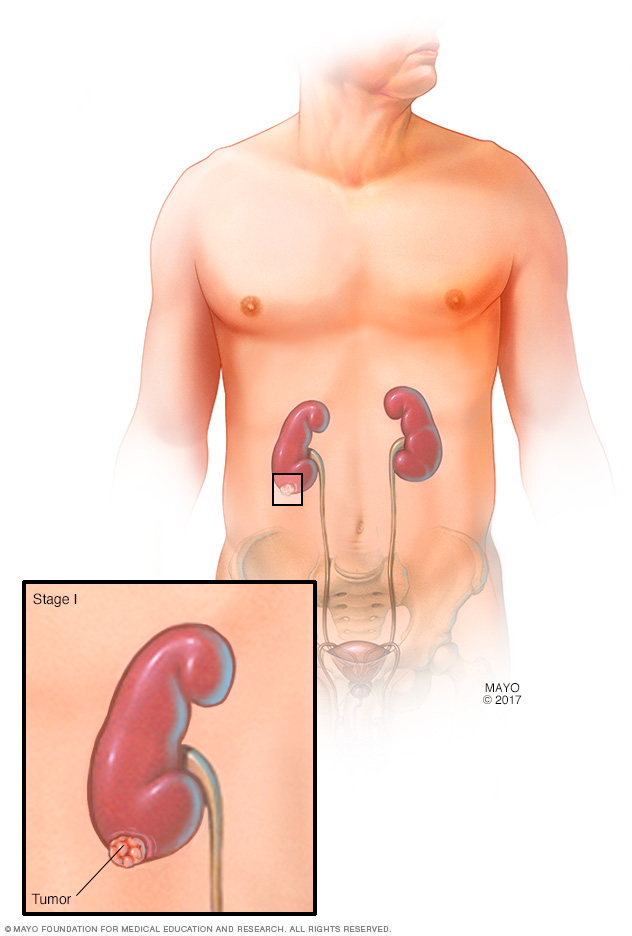 Stage I kidney tumor