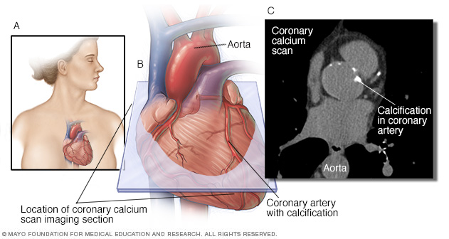 Coronary calcium scan