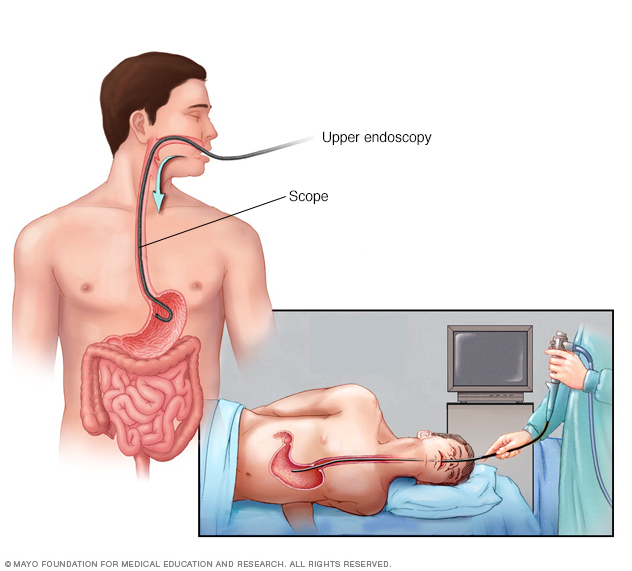 Upper endoscopy
