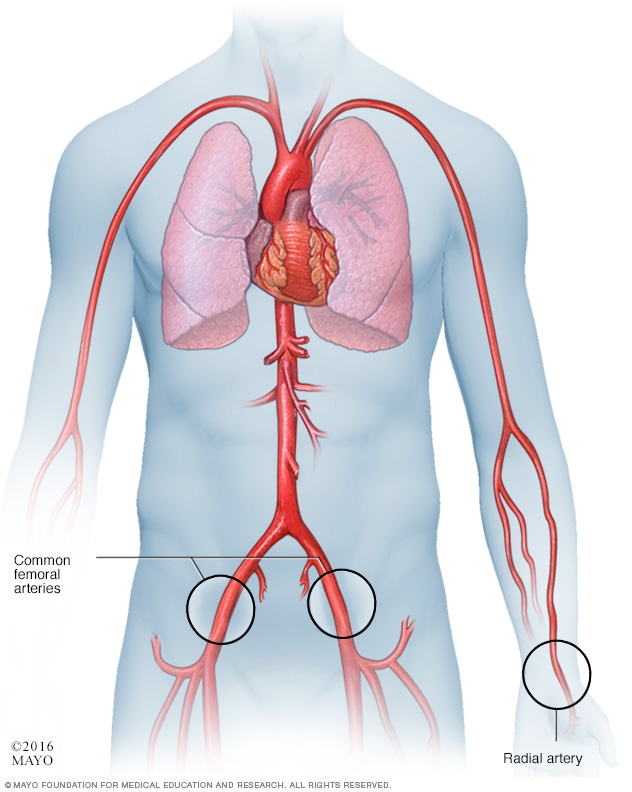 Catheter approaches in a cardiac catheterization procedure