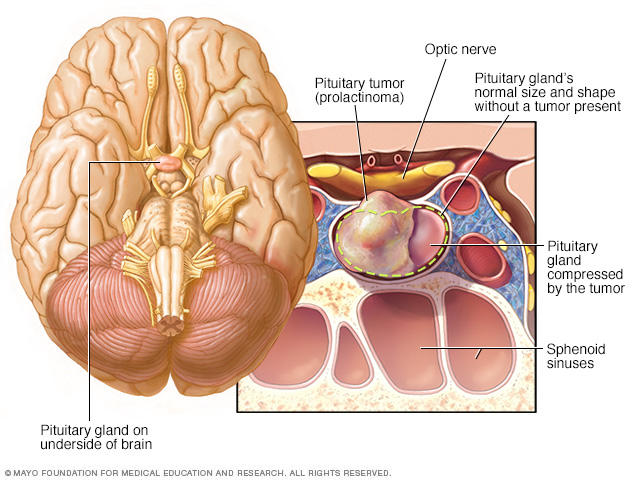 Prolactinoma in the pituitary gland