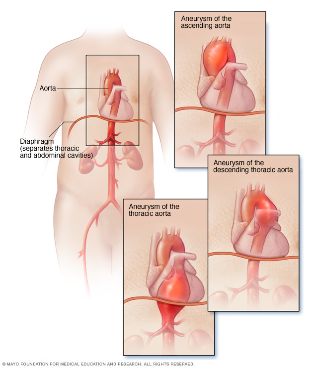 Thoracic aortic aneurysm