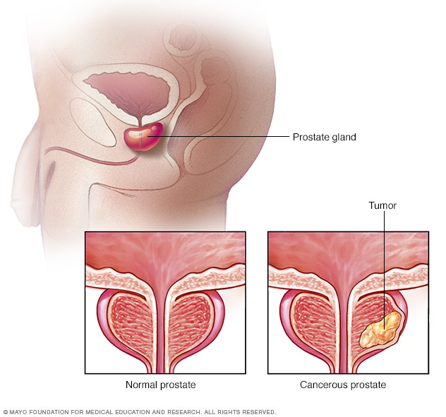 A typical prostate compared to a prostate with cancer