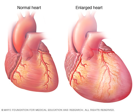 An enlarged heart
