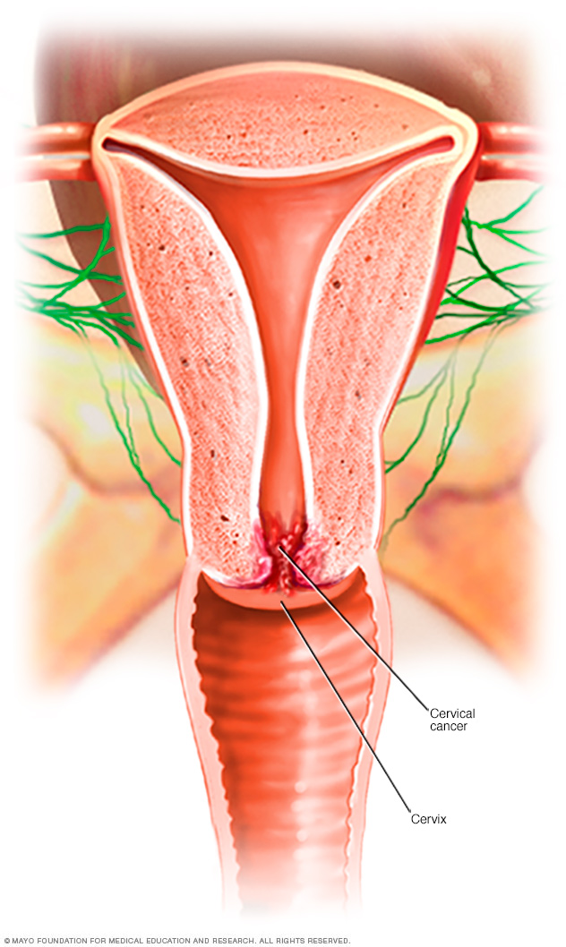 Cervical cancer 