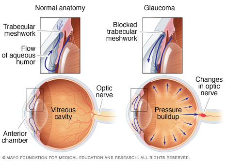 Open-angle glaucoma