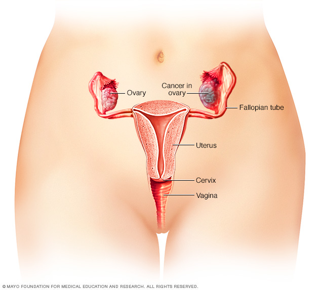 Ovarian cancer 