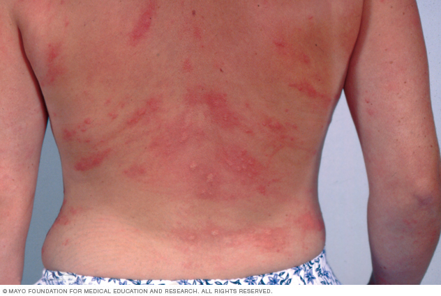 Swollen welts on the back of someone with hives