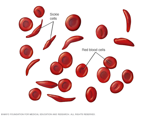 Red blood cells and sickle cells