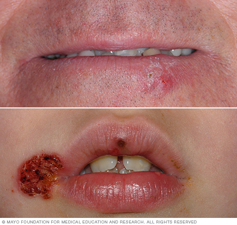 Cold sore on four different skin colors.