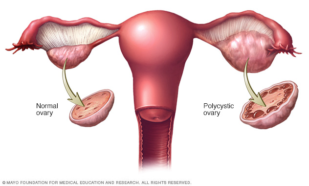 Healthy ovary and a polycystic ovary