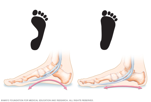 Comparing typical and flatfeet footprints