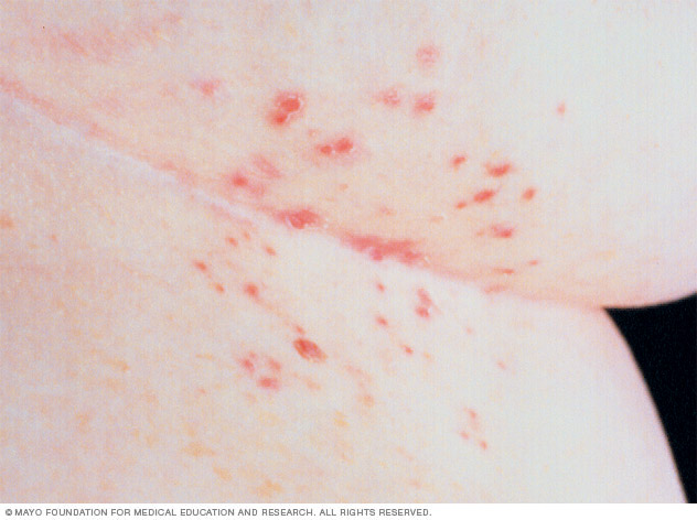 Scabies causes small, raised blisters on the skin