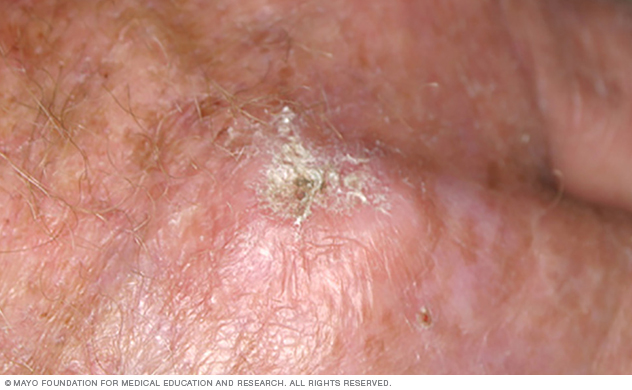 An actinic keratosis is a rough, scaly patch of skin.