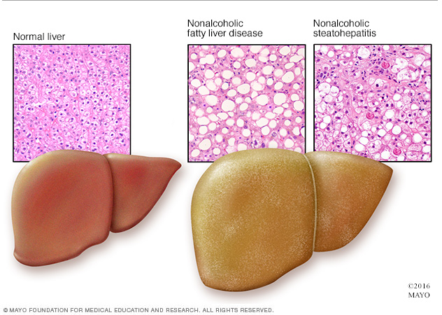Microscopic view of healthy liver and nonalcoholic fatty liver