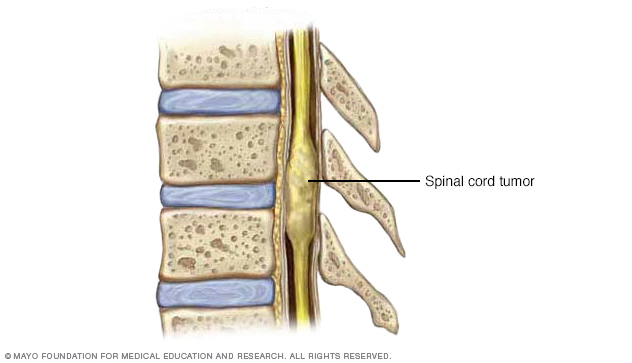Illustration showing a tumor in the interior of the spinal cord