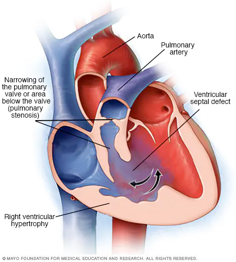Components of tetralogy of Fallot