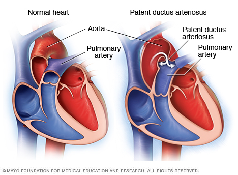 Illustration of a patent ductus arteriosus
