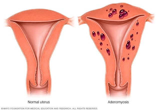 Normal uterus vs. uterus with adenomyosis