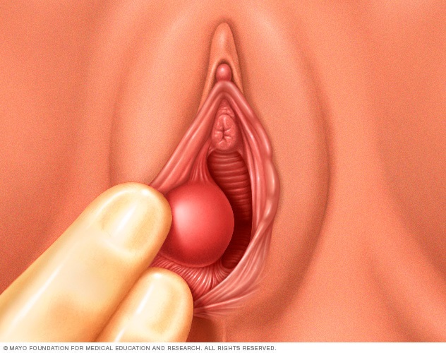 Illustration showing location of a Bartholin's cyst
