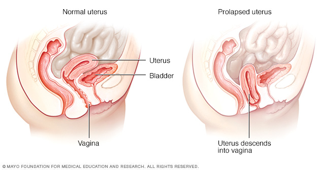 Typical uterus and prolapsed uterus