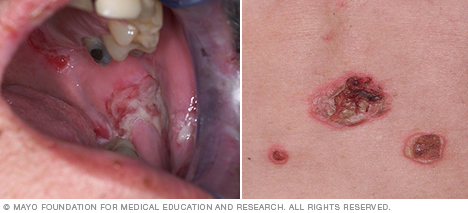 Pemphigus vulgaris of the mouth and skin 