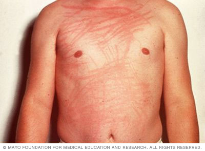 Scratched skin showing the raised lines or welts of someone with dermatographia.