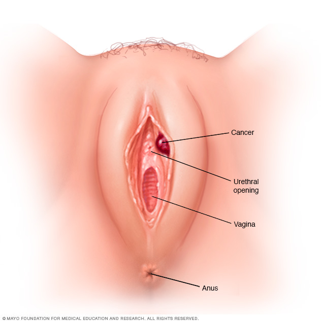 Vulvar cancer
