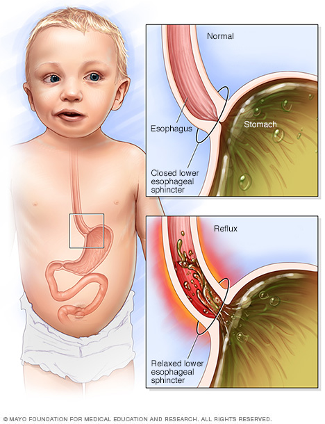 How infant reflux occurs