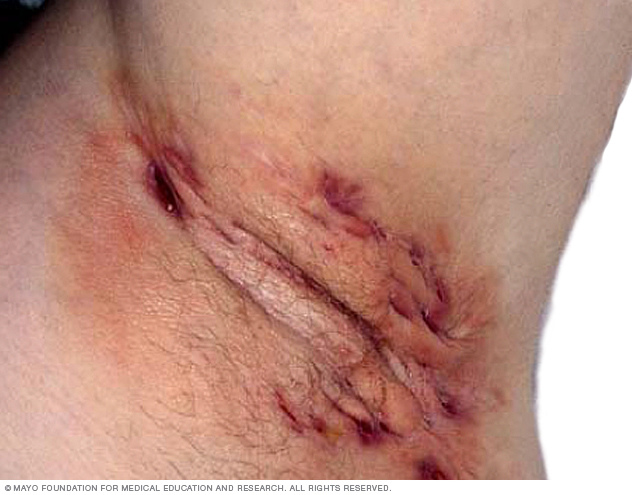 Hidradenitis suppurative commonly appears in the armpits.