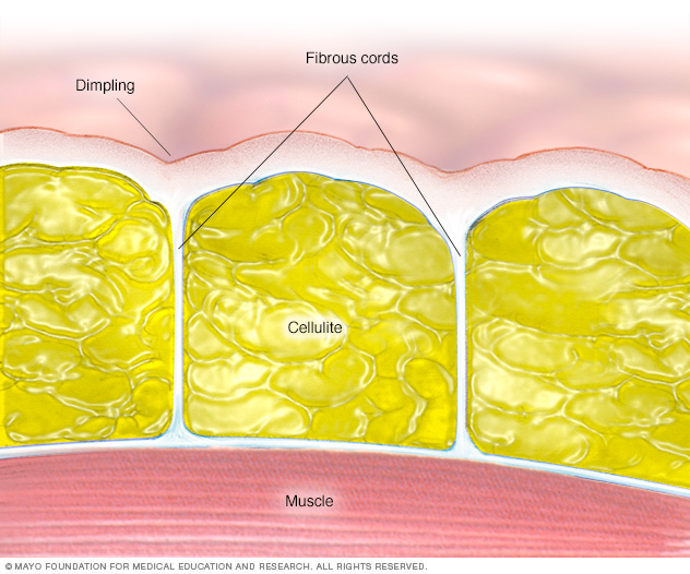 Anatomy of cellulite