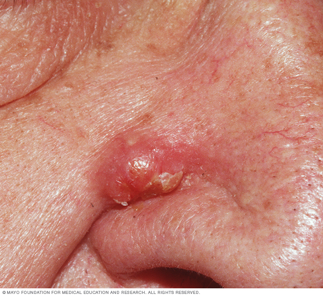 Inflamed epidermoid cyst on side of nose