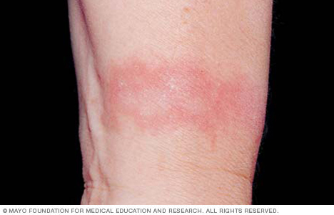 Contact dermatitis on the wrist might be caused by a watchband